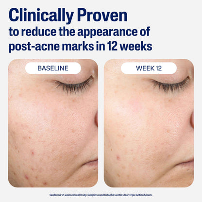 CETAPHIL Gentle Clear Repairing Post-Acne Serum, Retinol Alternative, Oil Free Serum for Sensitive Skin, 1 Fl Oz, Bakuchiol, Improves Skin Tone & Post-acne Marks,